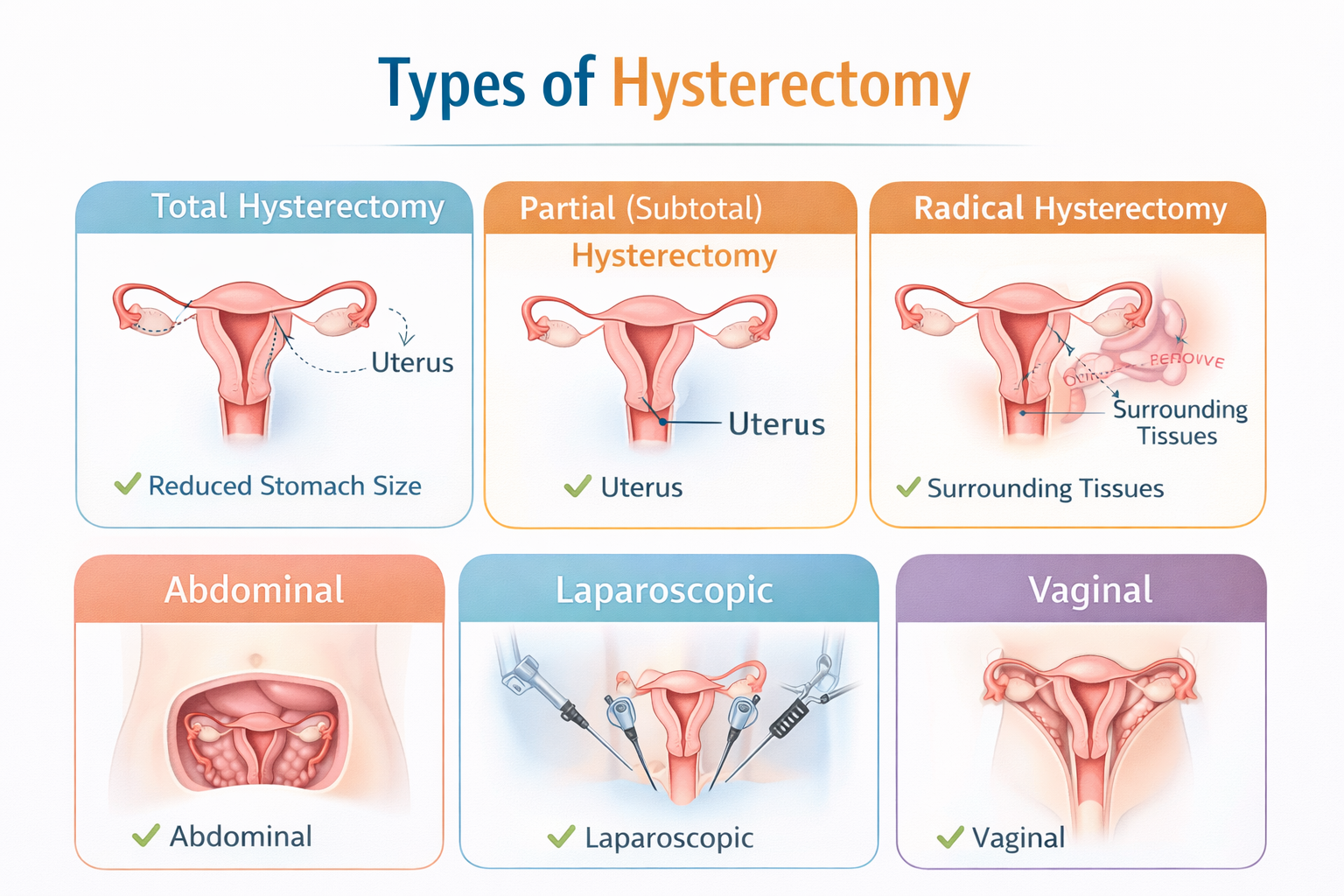 Types of Hysterectomy