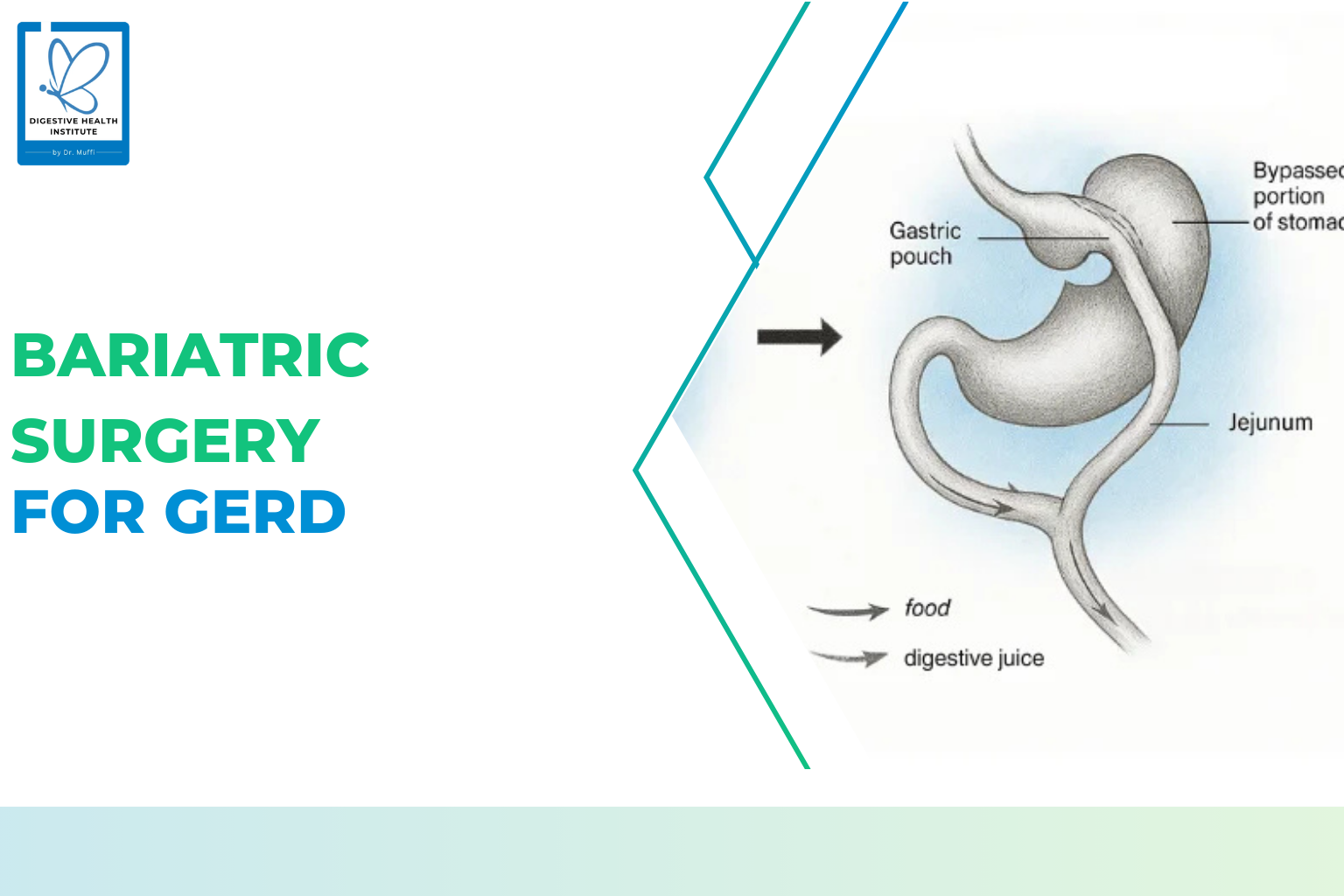 Bariatric Surgery for GERD: Can Weight Loss Surgery Cure Acid Reflux?