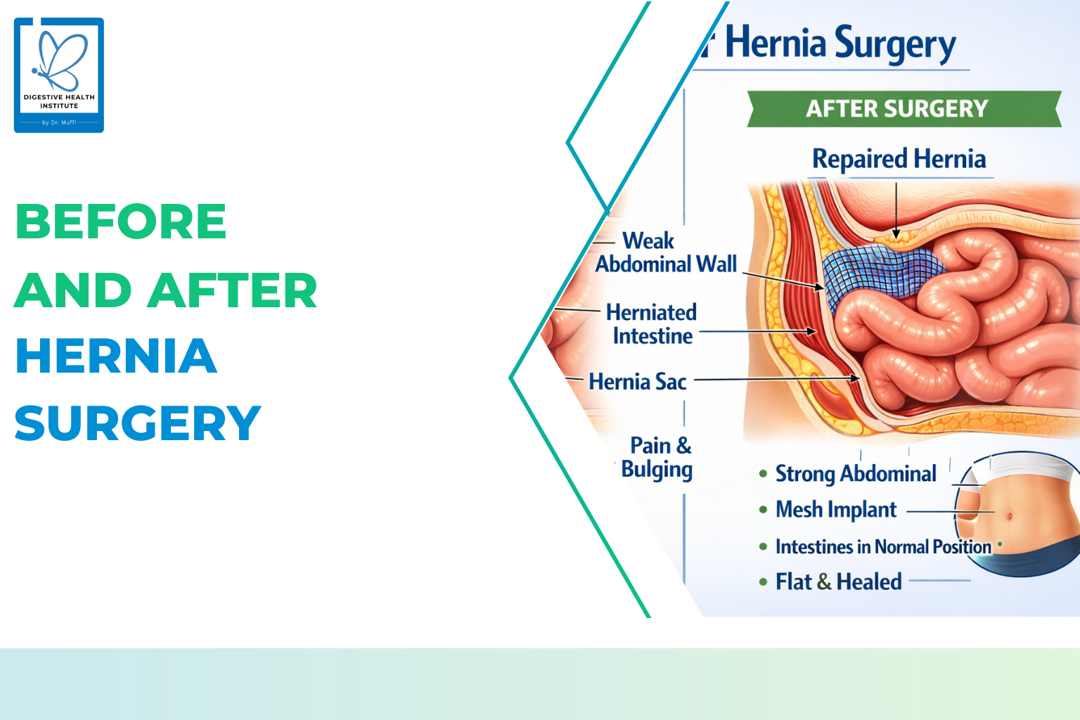Before and After Hernia Surgery