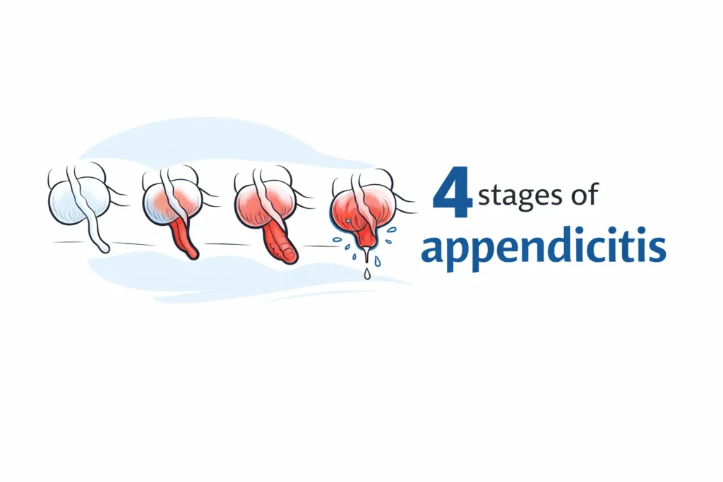 4 stages of appendicitis