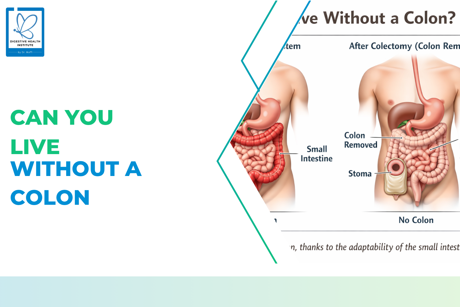 Can You Live Without a Colon