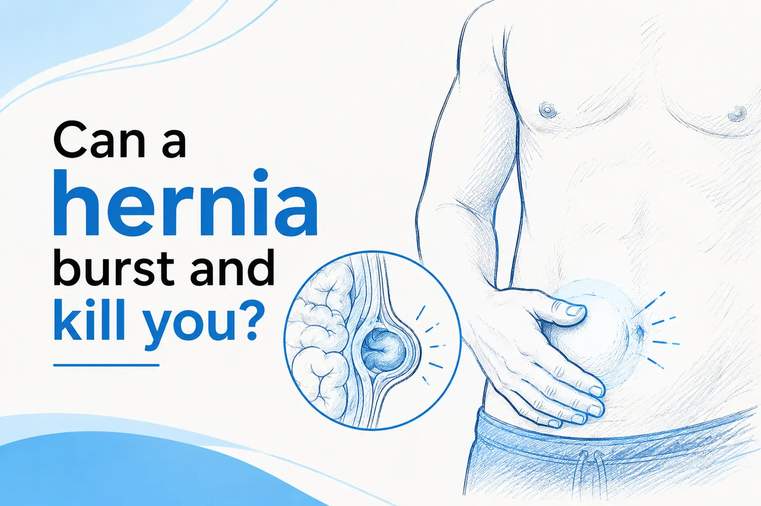 Can a hernia burst and kill you.