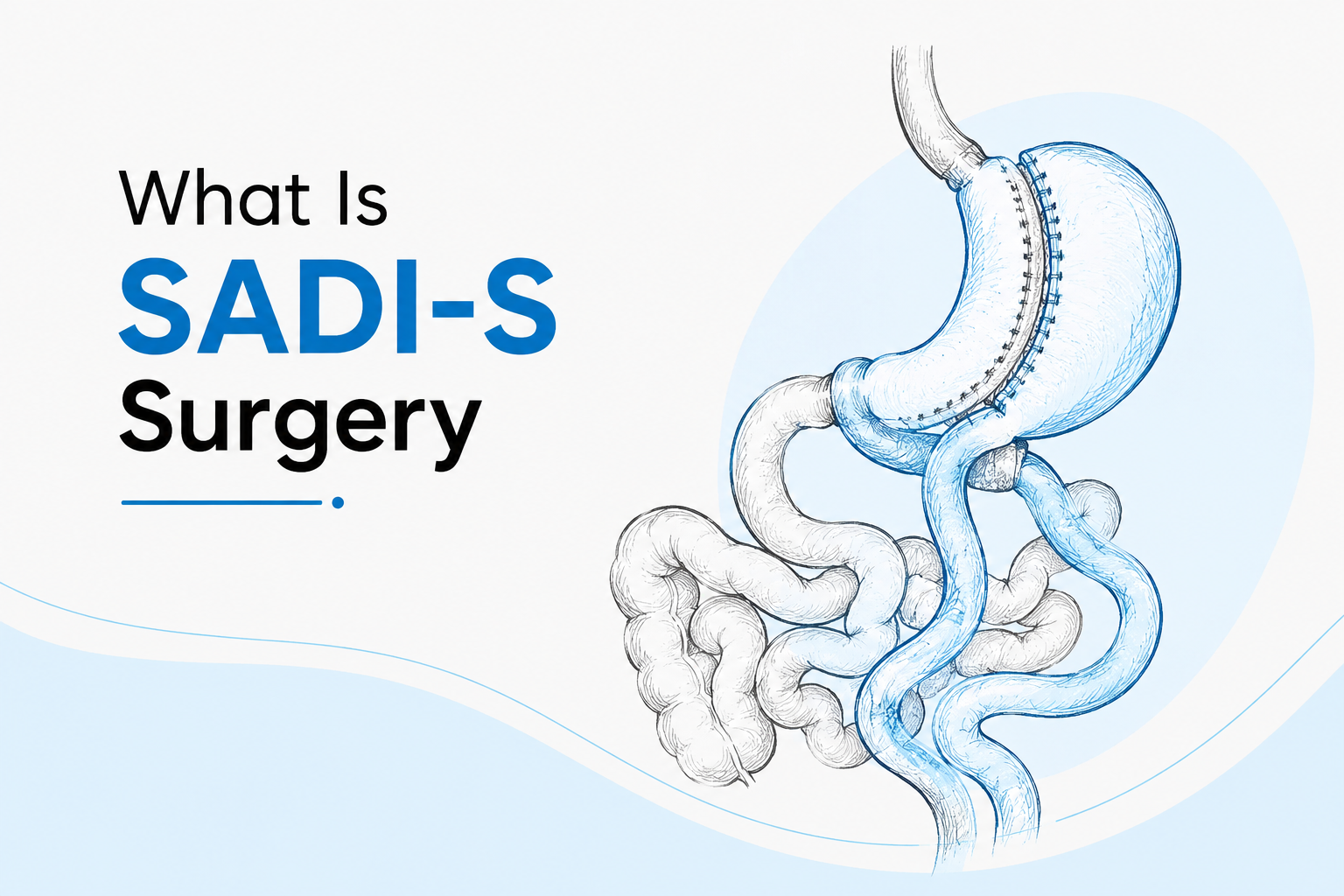 SADI-S Surgery