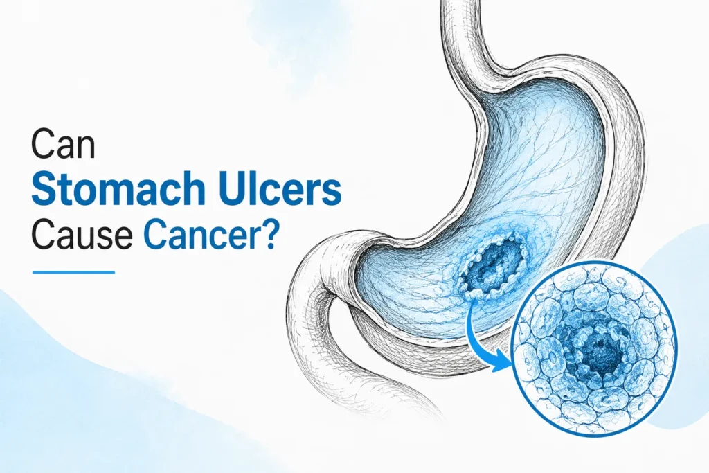 can stomach ulcers cause cancer