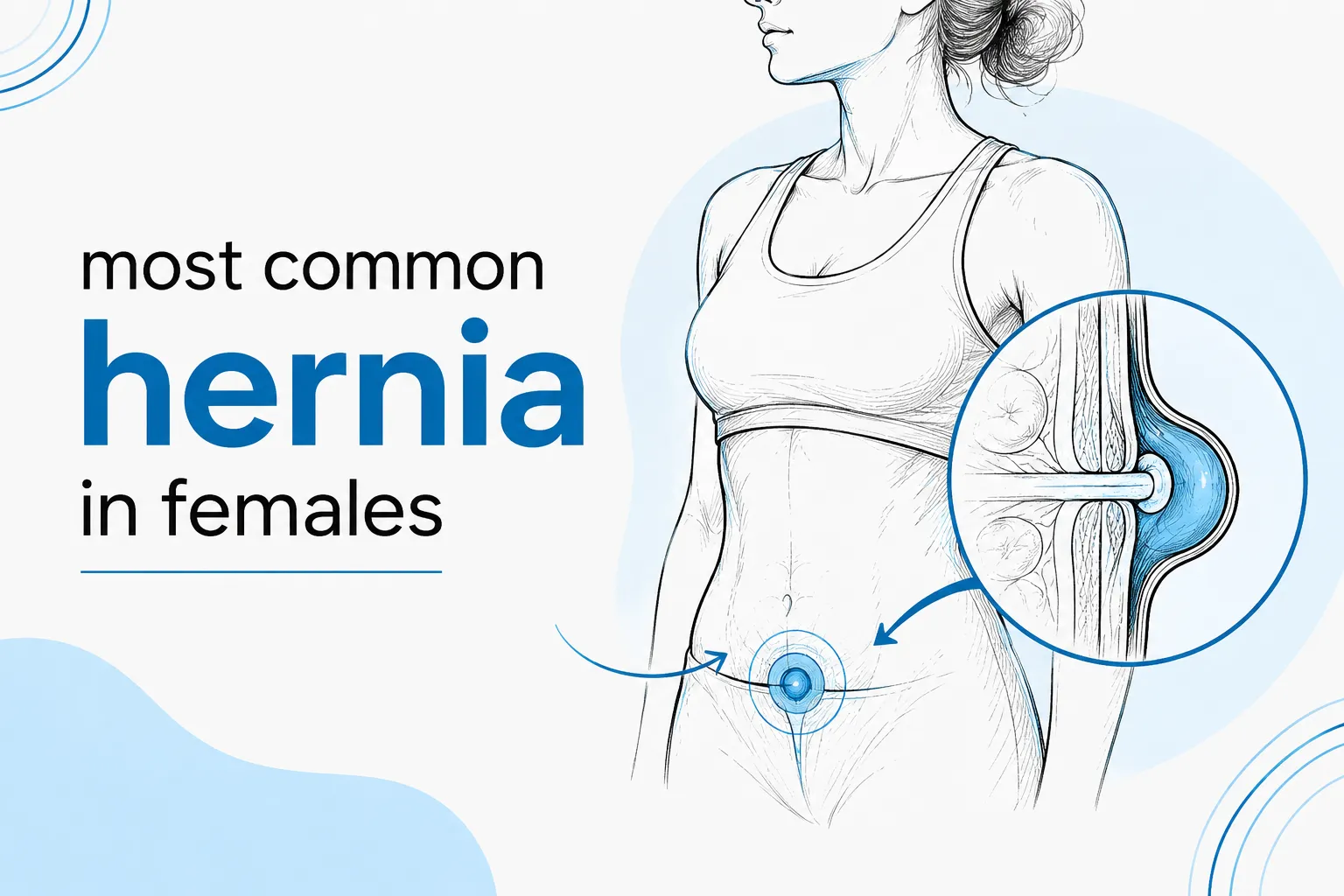 most common hernia in females
