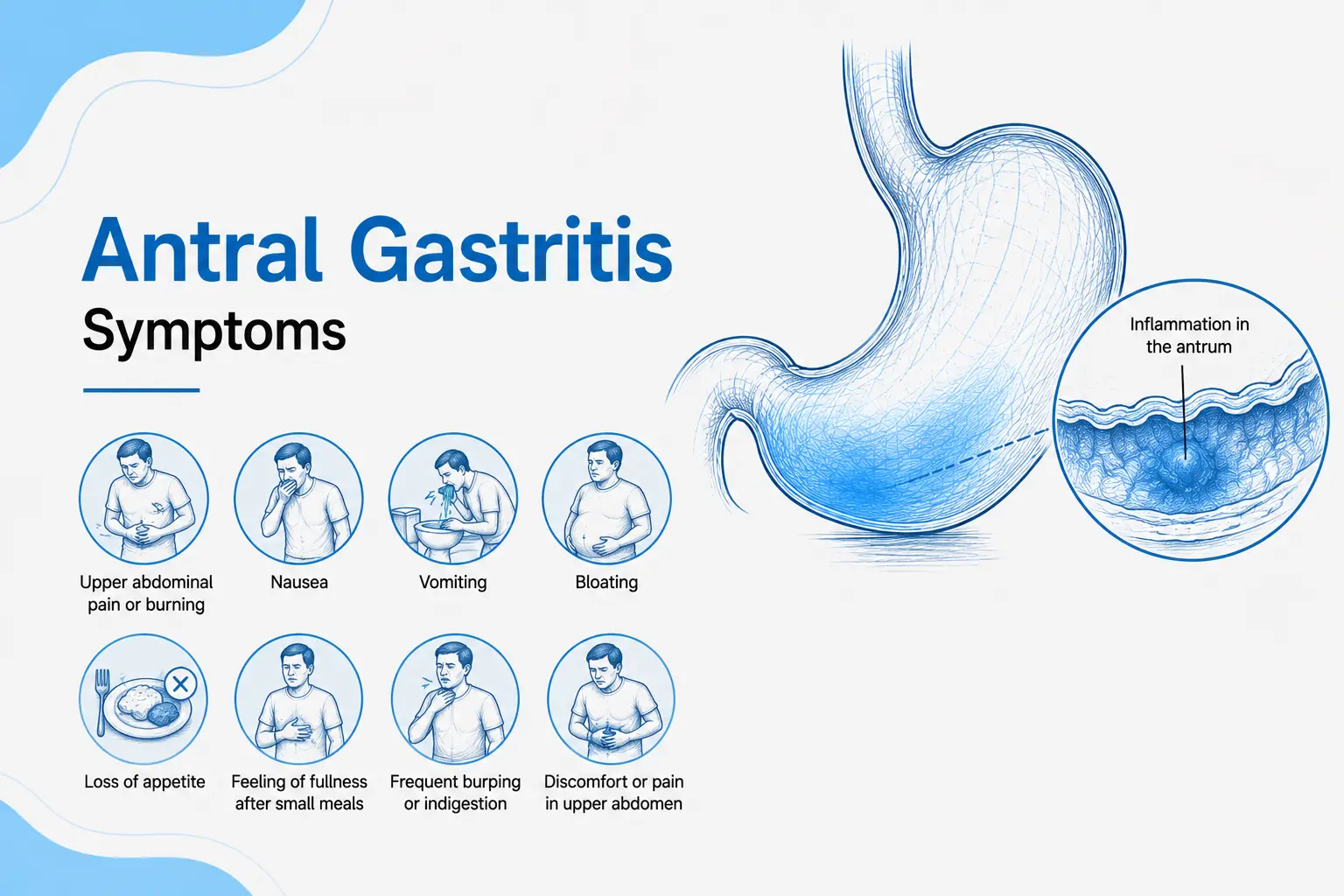 Sketch illustration of the stomach highlighting inflammation in the antrum and common antral gastritis symptoms, including upper abdominal pain, nausea, and bloating.