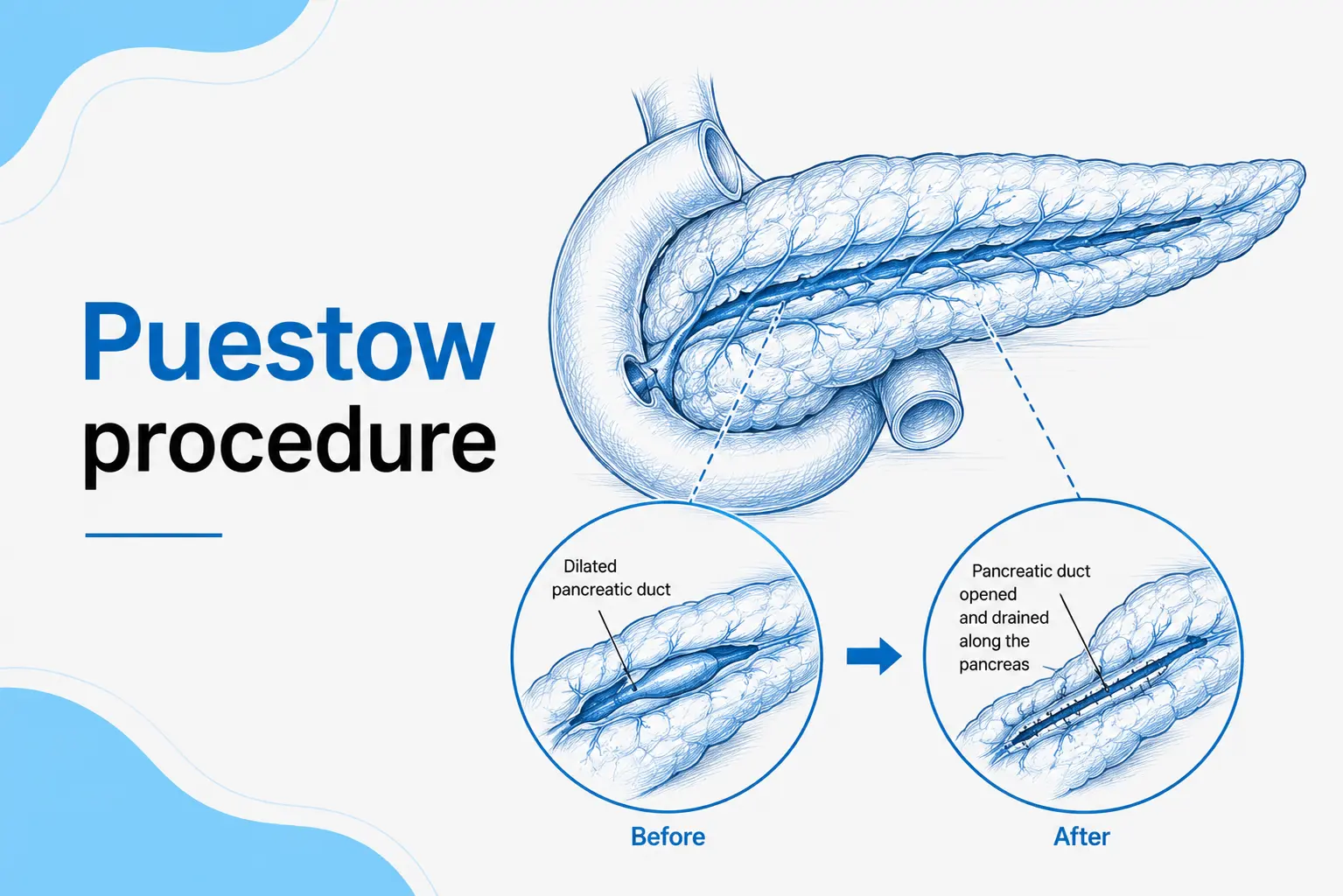 Sketch illustration showing the Puestow procedure with pancreatic duct drainage anatomy