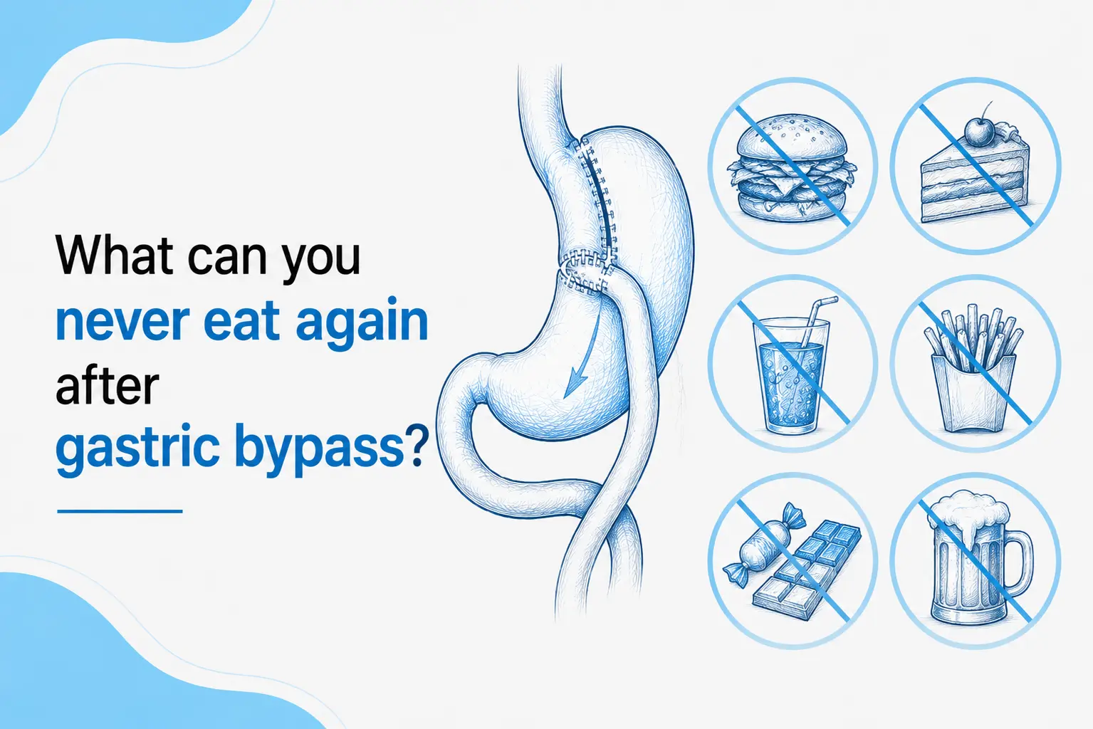 Sketch illustration of gastric bypass surgery with foods that should be avoided after the procedure
